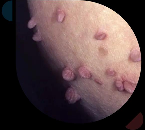 GenitalWarts-treated