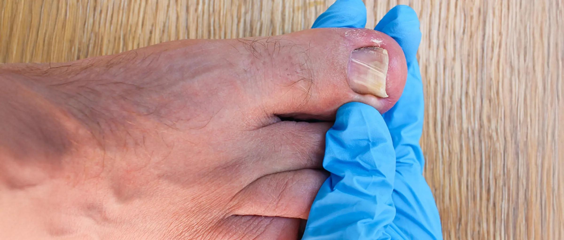 PreventionIngrownNail