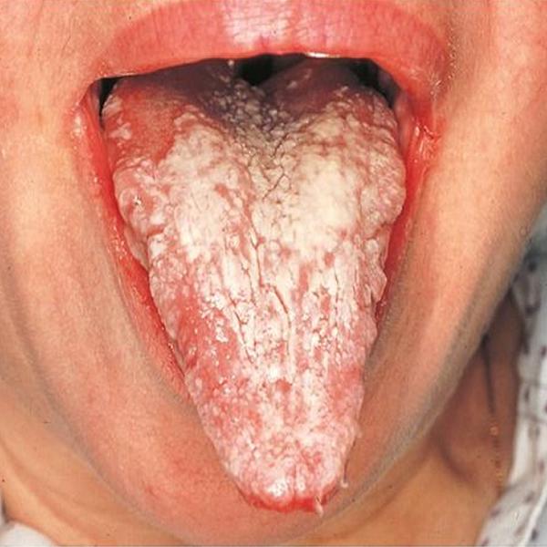 TransmitedChlamydia02