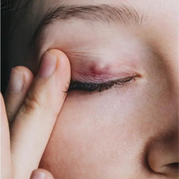 CausesStye