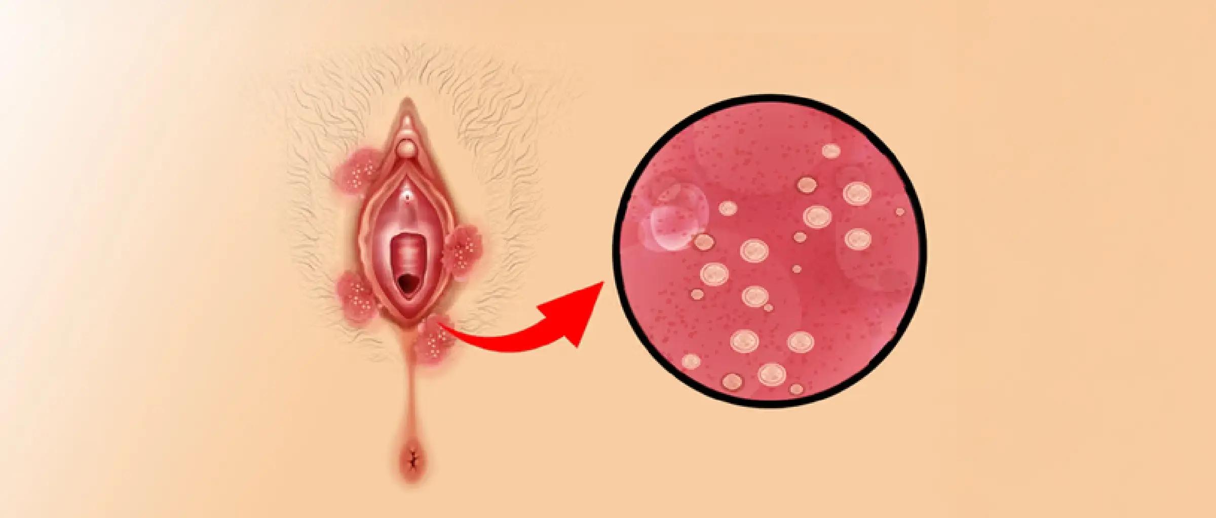 TransmissionGenitalHerpes